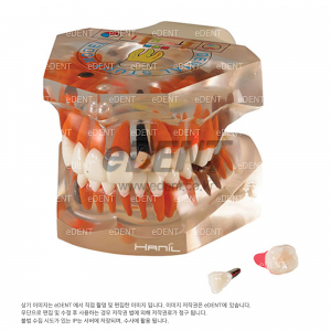 투명 임플란트 모델 (P-Type)