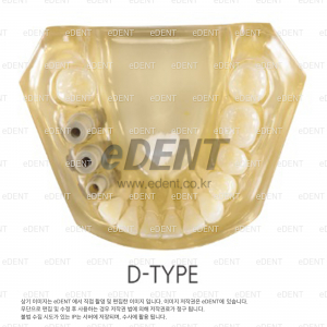 크리스탈 임플란트 모델(Crystal Implant Model-D type)