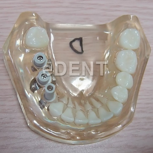 (주)이덴트 치과재료·치과의약품 전문,크리스탈 임플란트 모델(Crystal Implant Model-D type)