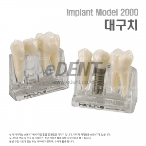 임플란트 설명용 비교 모델(Model 2000)