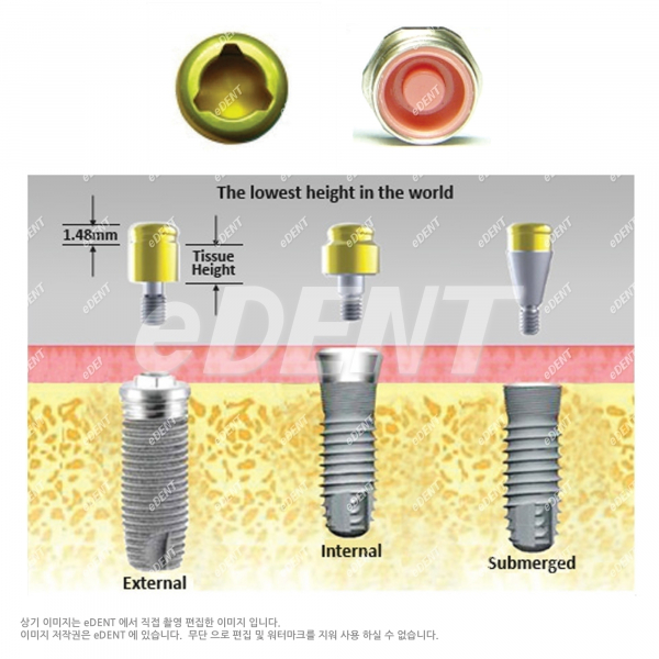 (주)이덴트 치과재료·치과의약품 전문,[교환/반품불가] Kerator Attachment (Internal)