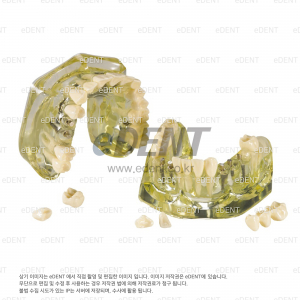 빅 임플란트 모델(Big Implant Model)