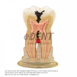 충치 설명 모델 (H-Type)