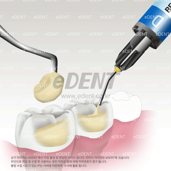 (주)이덴트 치과재료·치과의약품 전문,Beautifil-Bulk Flowable