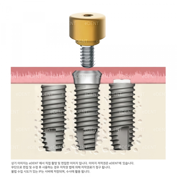 (주)이덴트 치과재료·치과의약품 전문,MagFit IP-I (keeper만)