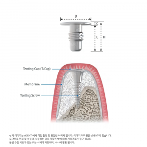 InnoGenic GBR Tenting Cap